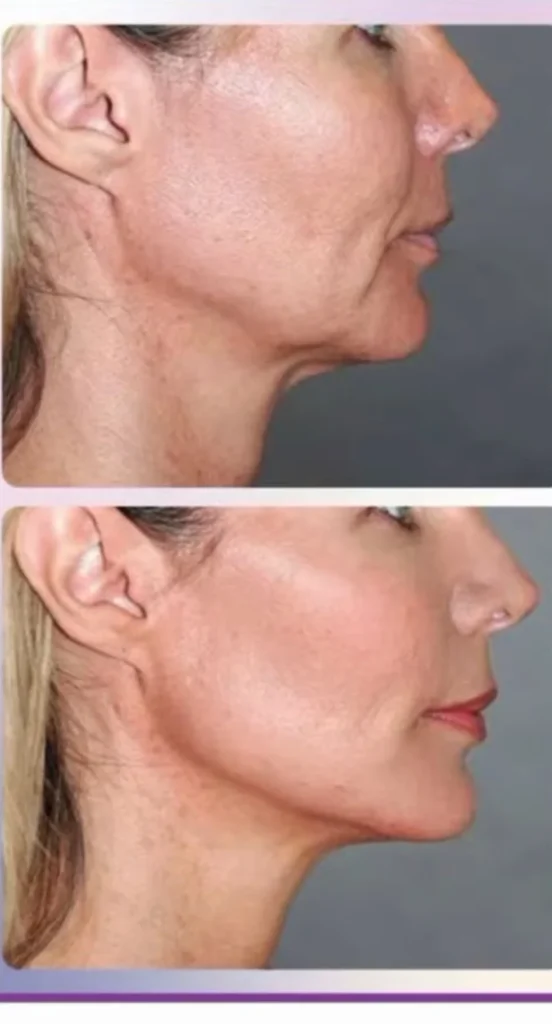 RFYNE İtalyan Estetiği