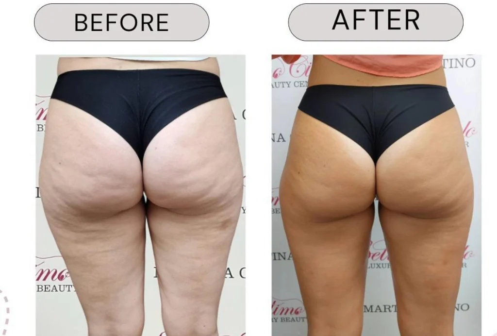 T-Shape 2 Yüz ve Vücut Şekillendirme Cihazı | Estezone Medikal