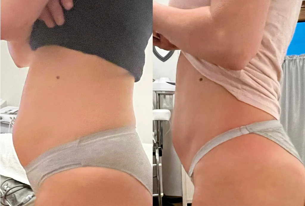 T-Shape 2 Yüz ve Vücut Şekillendirme Cihazı | Estezone Medikal