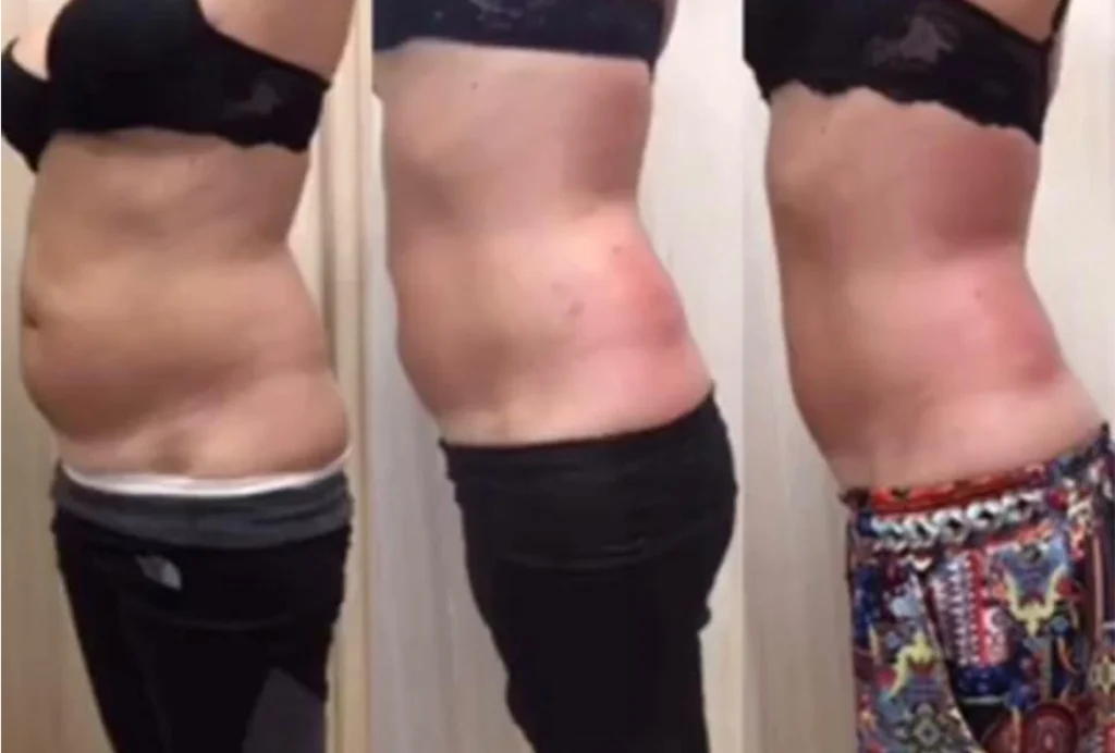 T-Shape 2 Yüz ve Vücut Şekillendirme Cihazı | Estezone Medikal