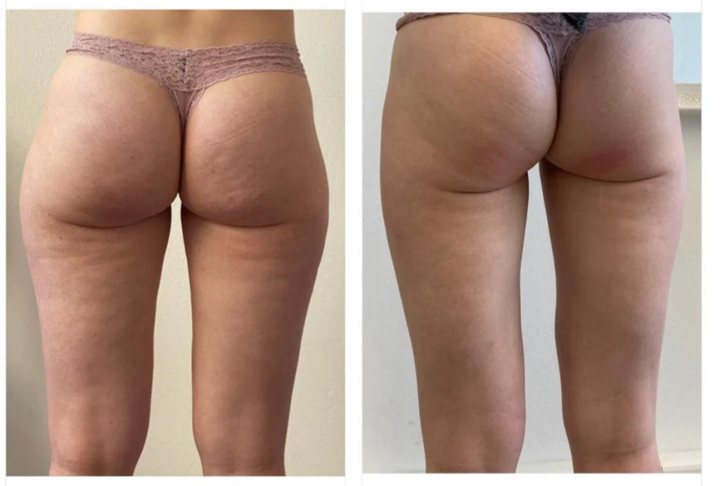 T-Shape 2 Yüz ve Vücut Şekillendirme Cihazı | Estezone Medikal