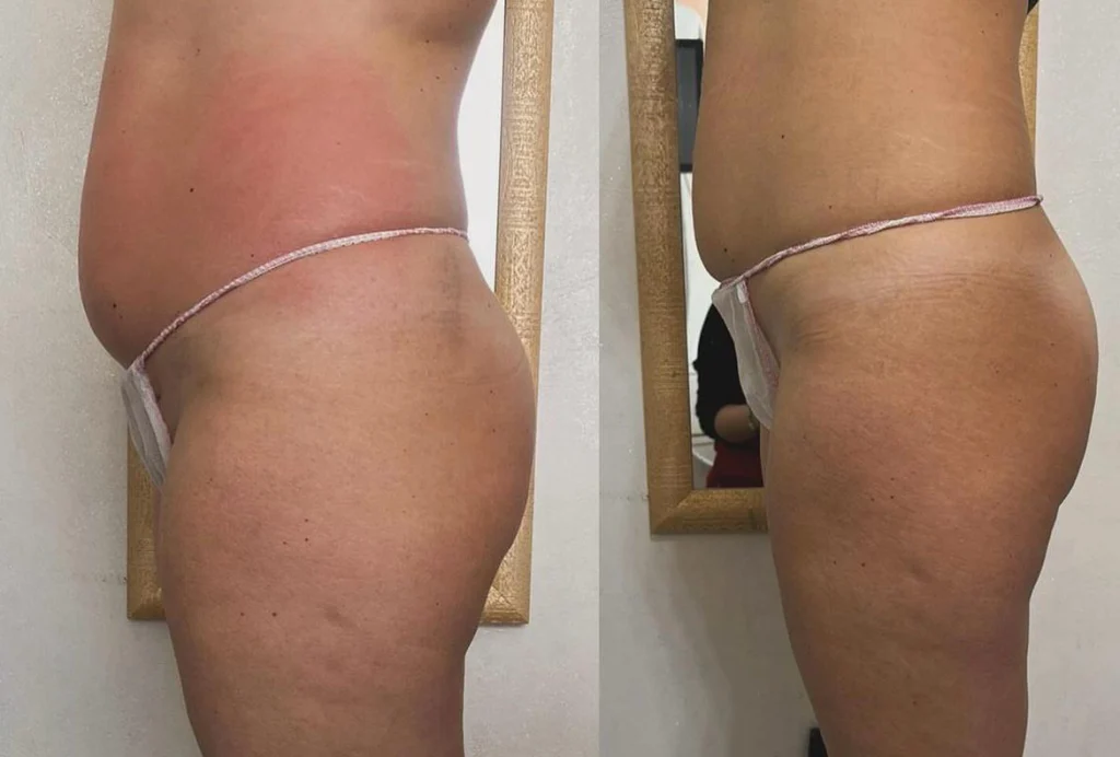 T-Shape 2 Yüz ve Vücut Şekillendirme Cihazı | Estezone Medikal