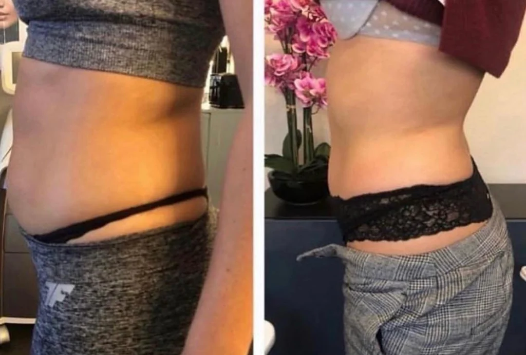 T-Shape 2 Yüz ve Vücut Şekillendirme Cihazı | Estezone Medikal